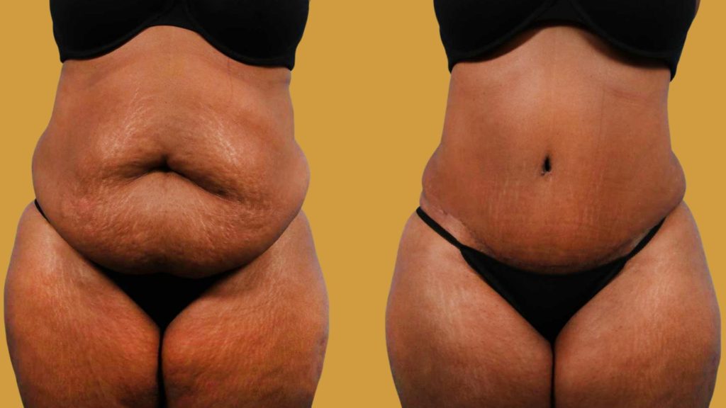 What Is Lipo 360?