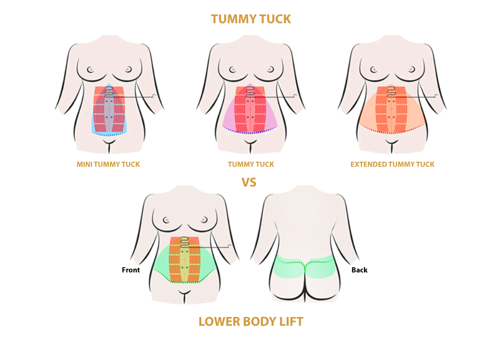 What Is an Extended Tummy Tuck: Understanding Circumferential Body Lift