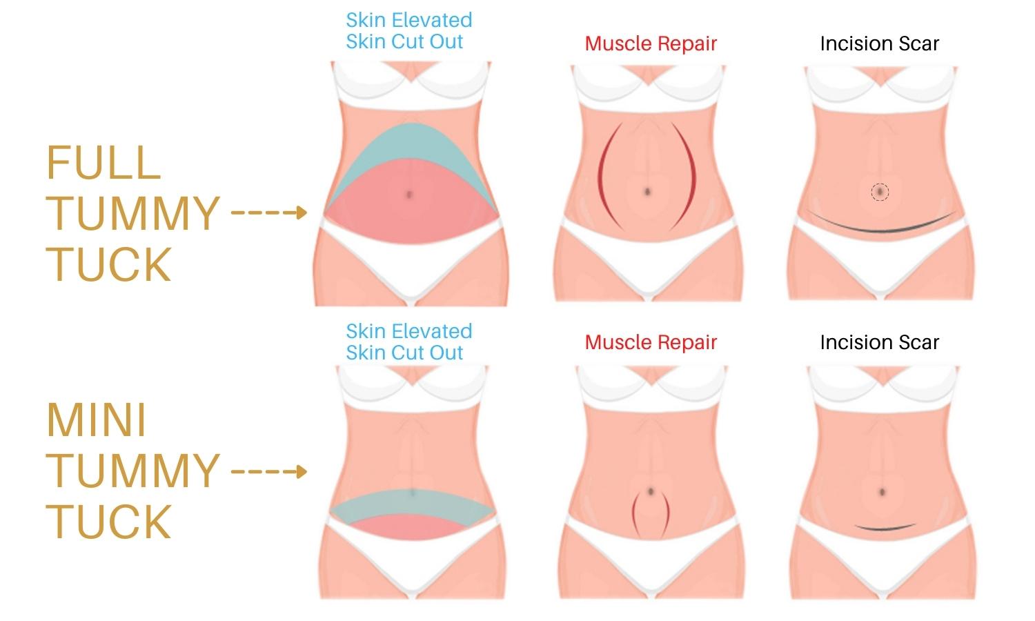 Scarless Tummy Tuck - Is it Possible?