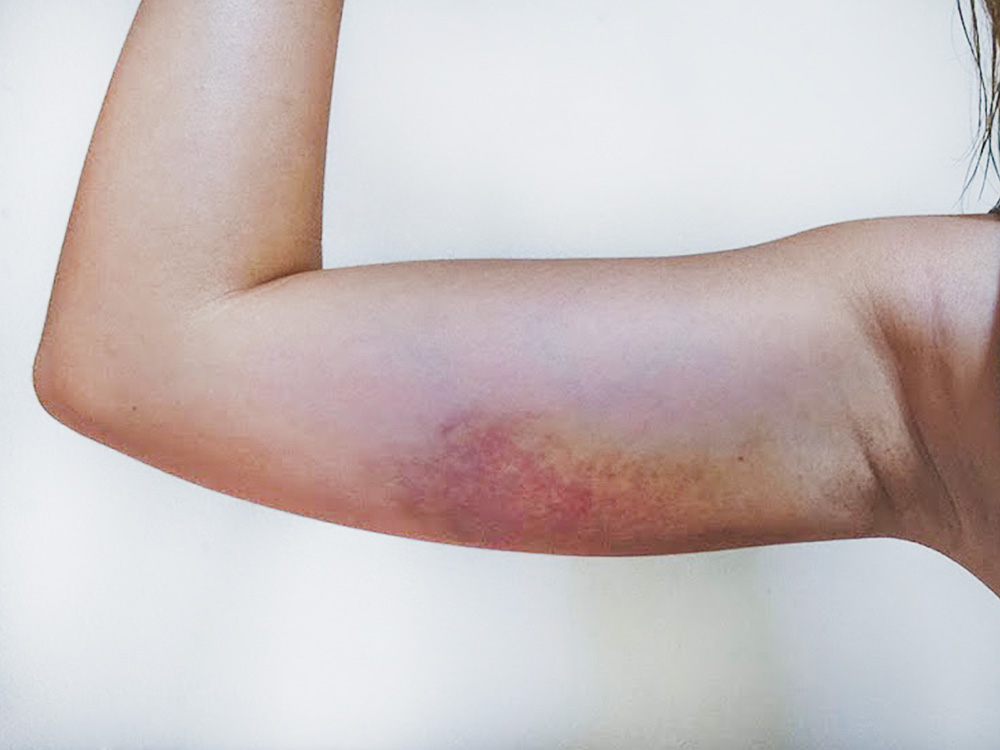 bruise on arm