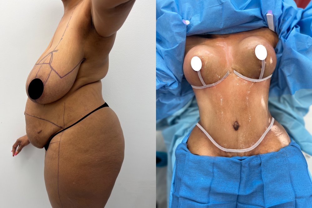 Limited-Time Offer: Get Liposuction Miami for Only $2800!