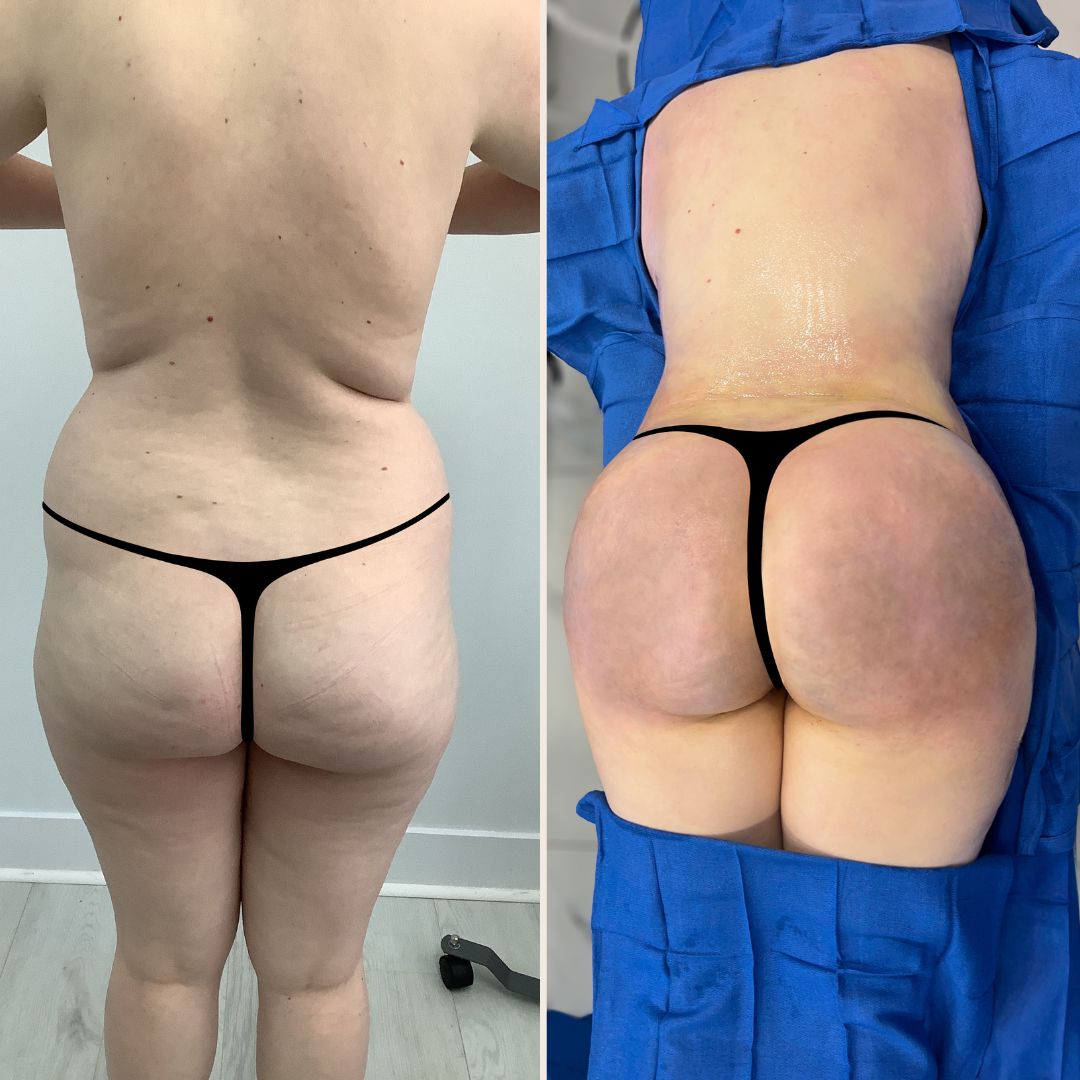BBL (Brazilian Butt Lift) and High Definition Liposuction FULL
