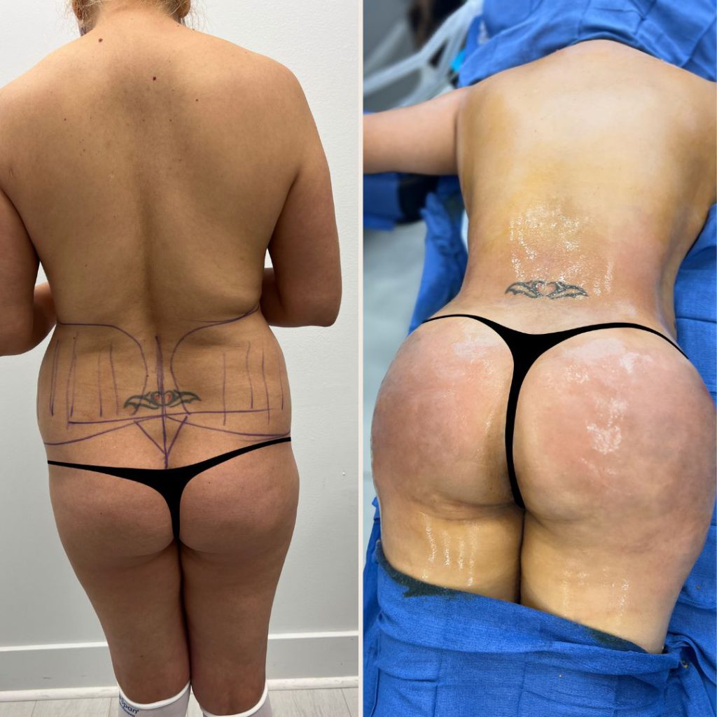 Photos before and after butt augmentation with implants, BBL