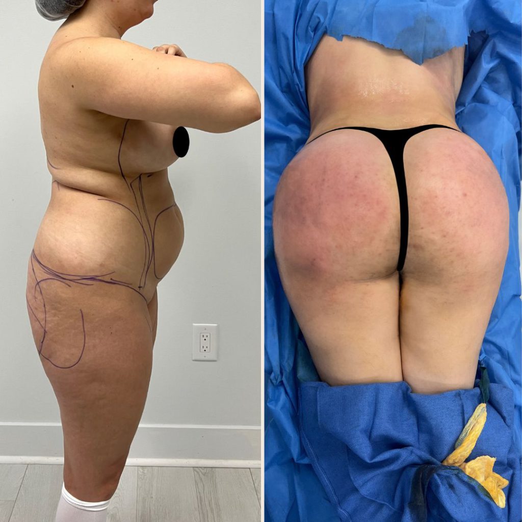 Brazilian Butt Lift Before and After Pictures - Moon Plastic Surgery